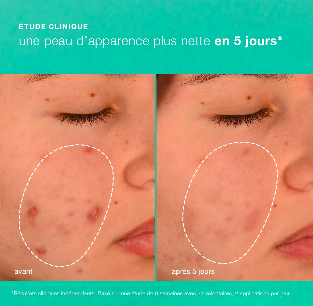 Breakout Biotic Moisturizer Test.webp
